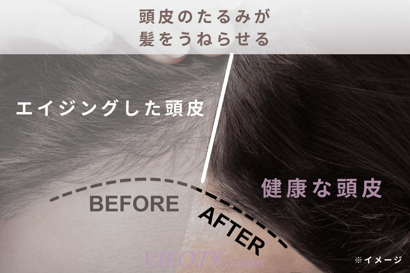 「頭皮のたるみが、髪をうねらせる」のテキストと共に、頭皮のエイジングによる毛穴の歪みを示す図解。40代からのくせ毛の原因を科学的に解説。